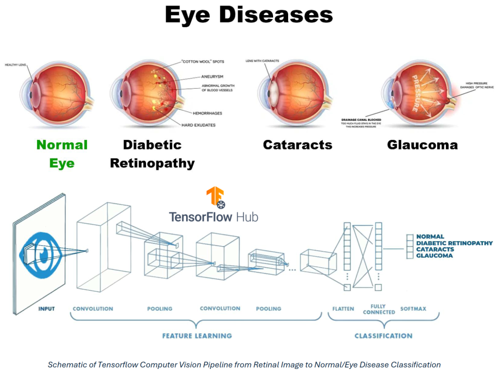 Schematic of Tensorflow Computer Vision Pipeline from Retinal Image to Normal/Eye Disease Classification